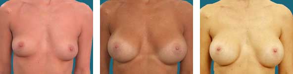 alpharetta breast surgeon