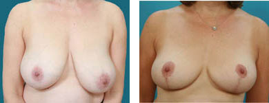 Breast Reduction / Reduction Mammaplasty surgeon in atlanta georgia