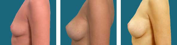 atlanta breast surgery results