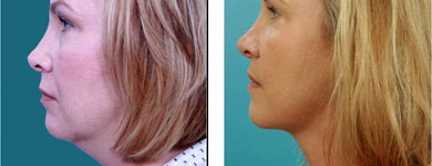 Chin Augmentation Before and after photos, Sandy Springs, GA