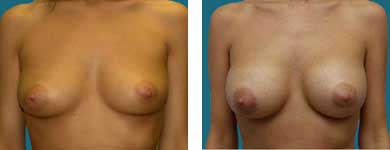 breast procedures