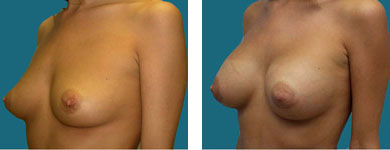 atlanta plastic surgery results