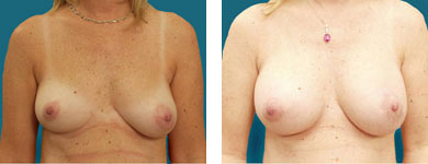 breast surgeon alpharetta