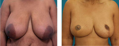 atlanta nipple reconstruction