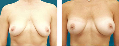 Breast Augmentation / Breast Enhancement