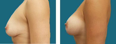 atlanta breast enhancement surgeon