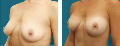 results of breast enhancement