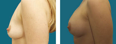 procedure of the breast