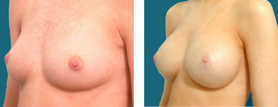 phots of breast enhancement