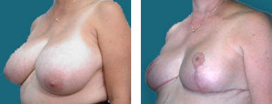 fraklyn elliott breast reduction surgeon