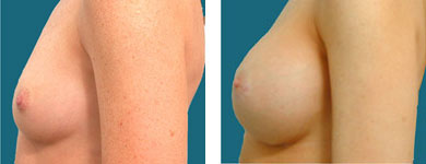 Breast Augmentation / Breast Enhancement