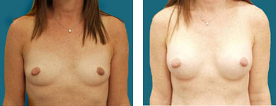 elliott breast enhancement patient
