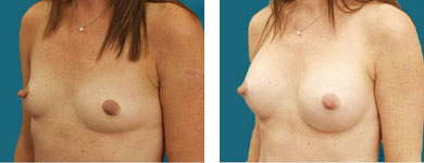 breast procedure in atlanta