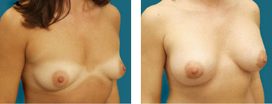 patient breast photos