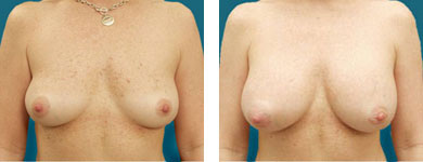 breast enhancement pictures