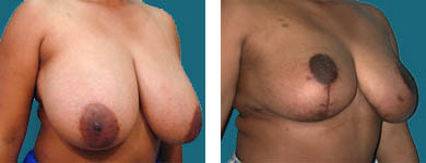 Breast Reduction / Reduction Mammaplasty