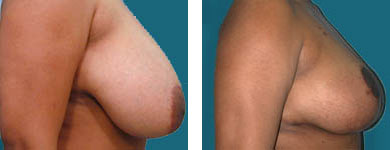 Breast Reduction / Reduction Mammaplasty