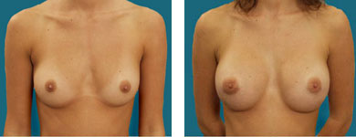 atlanta plastic surgeon breast photos 