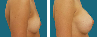 frank elliott breast augmentation pictures