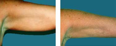 liposuction arm lift