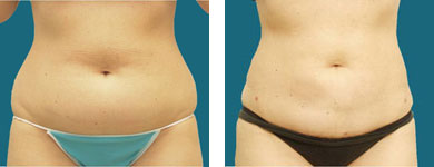 liposuction photos