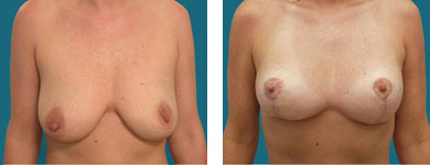 franklyn elliott md breast lift photos