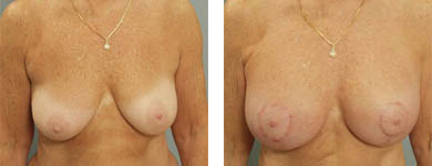 atlanta breast surgery
