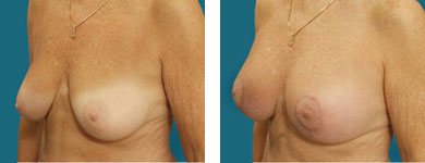 before and after Breast Lift / Mastopexy photos