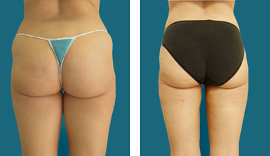 before and after liposuction photos