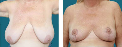 atlanta georgia Breast Reduction / Reduction Mammaplasty surgeon
