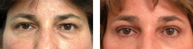 Eyelid Surgery / Blepharoplasty