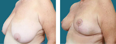 Breast Reduction / Reduction Mammaplasty photos 