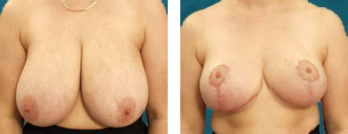 breast plastic surgery procedures