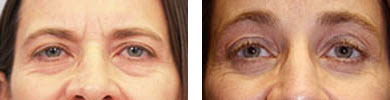Eyelid Surgery / Blepharoplasty before and after photos