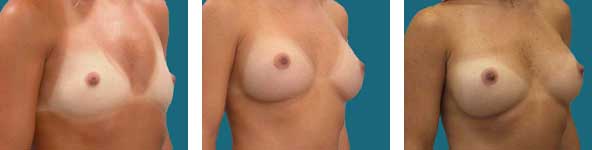 cosmetic surgery of the breast