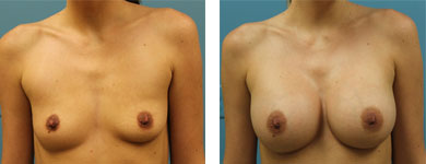 breast augmentation atlanta ga