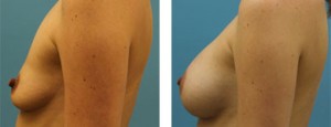 breast implants atlanta ga
