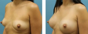 silicone breast implants atlanta