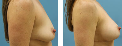 silicone breast implants atlanta