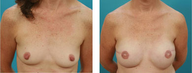 atlanta Breast Reconstruction surgery
