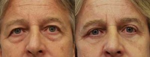 Eyelid Surgery / Blepharoplasty