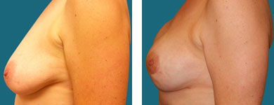 breast implants and breast reconstruction