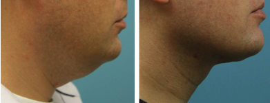 neck-lift-liposuction-atlanta-alpharetta-ga-01