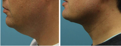 neck-lift-liposuction-atlanta-alpharetta-ga-02
