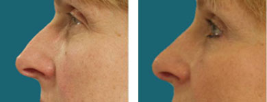 Nose Surgery / Rhinoplasty