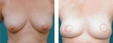 tram flap breast reconstruction