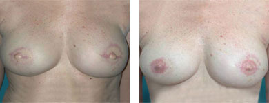 breast reconstruction in atlanta and alpharetta 