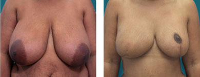 breast reconstruction dr elliott