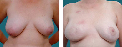 breast reconstruction surgery techniques