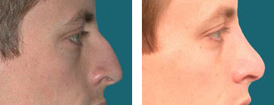 Nose Surgery / Rhinoplasty